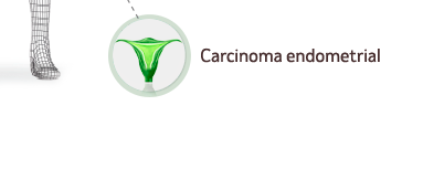 Imagen indicación Carcinoma endometrial
