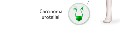 Imagen indicación carcinoma urotelial